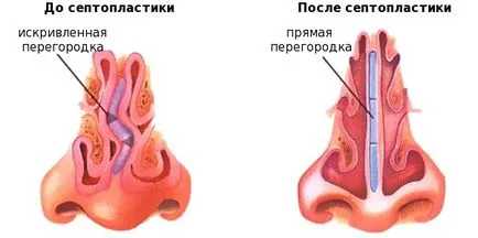 Cum de a stabili septul nazal
