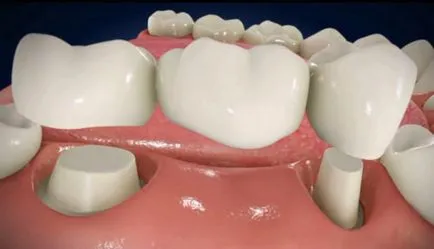 Proteza sau implantare