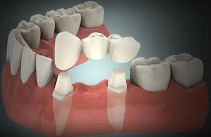 Proteza sau implantare