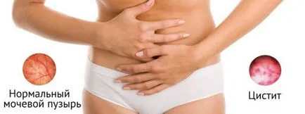 Simptome cum ar fi cistita Simptome cum ar fi cistita