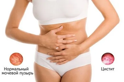 Simptome cum ar fi cistita