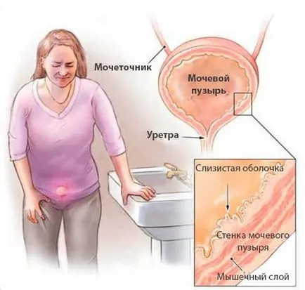 Simptome cum ar fi cistita Simptome cum ar fi cistita