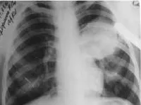 Diagnosticul bolii hidatice