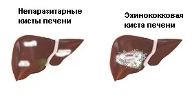 Diagnosticul bolii hidatice