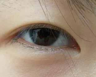 Epicanthus ce este