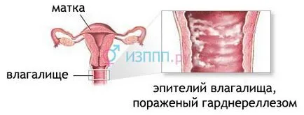 ADN-ul Gardnerella vaginalis l ADN-ul Gardnerella vaginalis l
