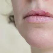Cât de repede vindeca herpesul