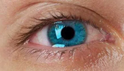 Ca hipermetropie corectat Ca hipermetropie corectat