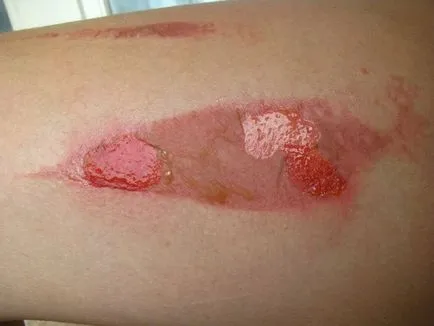 Ce se va întâmpla în cazul în care puncția arde Ce se va întâmpla în cazul în care puncția arde