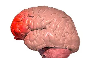 tratamentul cerebel