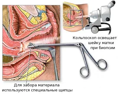 Analiza biopsii pentru care Analiza biopsii pentru care