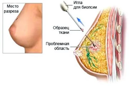 Analiza biopsii pentru care Analiza biopsii pentru care