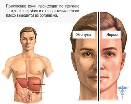 De ce albii galbene ale ochilor