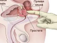 Prostatita la bărbați cauze Prostatita la bărbați cauze