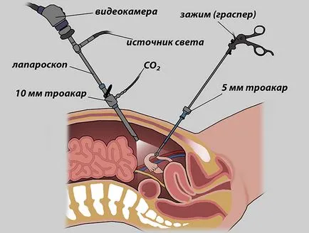 rezecția ovarian pentru ce