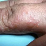 Erupții cutanate și mâncărime, care este
