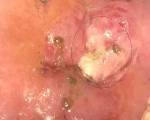 Ureaplasmosis cum să trateze