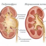 Presiune intracraniană la sugari tratate
