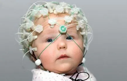 Presiune intracraniană la sugari tratate