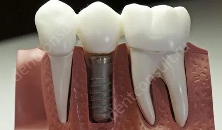 Proteza sau implantare Proteza sau implantare