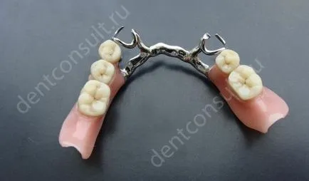 Proteza sau implantare Proteza sau implantare