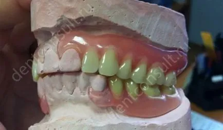 Proteza sau implantare Proteza sau implantare