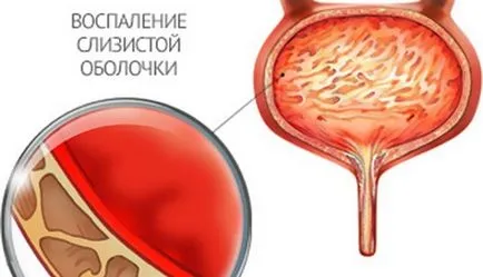 Cum de a trata inflamația vezicii urinare Cum de a trata inflamația vezicii urinare
