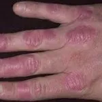 Alergia la apa de la robinet cauzele si simptomele de alergie (cauze) alergic la apa din cauzele robinet și simptomele de alergie