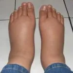 Alergia la apa de la robinet cauzele si simptomele de alergie (apa) alergic la apa din cauzele robinet și simptomele de alergie
