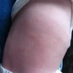 Alergia la cauzele de apa de la robinet si simptomele de alergie (de la robinet) alergic la apa din cauzele robinet și simptomele de alergie