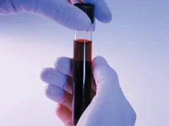 Analiza creatininei din sânge este folosit pentru diagnosticarea bolilor (analiza) Analiza creatininei din sânge este folosit pentru diagnosticarea bolilor