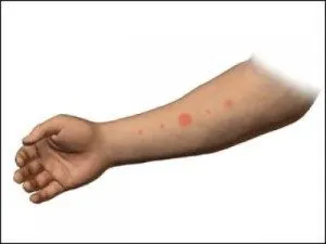 Simptomele alergice și tratarea apei