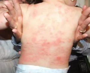 Alergia la spălare copii pulbere fotografie, alergii la copii