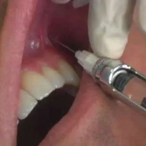 Anestezia în practică dentară variații, indicații, contraindicații, moderne (practica) Anestezia în stomatologie variațiilor de practică, indicații, contraindicații, moderne