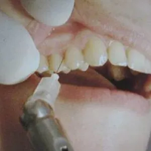Anestezia în practică dentară variații, indicații, contraindicații, moderne (mărturie) Anestezia în stomatologie variațiilor de practică, indicații, contraindicații, moderne