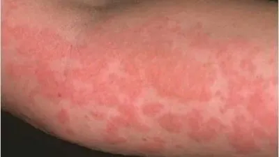 Alergia la praf de spălat ca simptomele apar la copii și adulți (detergent de rufe pentru cei care suferă de alergii) Alergia la praf de spălat simptome asemănătoare la copii și adulți par