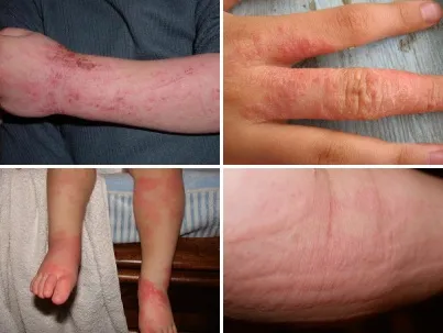 Alergia la praf de spălat - simptome, tratament, fotografii, revista on-line - alergie (foto) Alergia la praf de spălat - simptome, tratament, fotografii, revista on-line - alergie