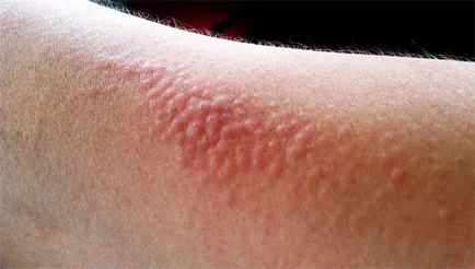 Alergia decât apa pot fi prevenite, și ce tratament este selectat (posibil) Alergia la apă decât pot fi prevenite si ce tratament pentru a alege