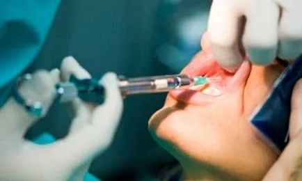 Anestezia în stomatologie, ceea ce se întâmplă specii (anestezie) Anestezia în stomatologie, ceea ce se întâmplă vizualizări