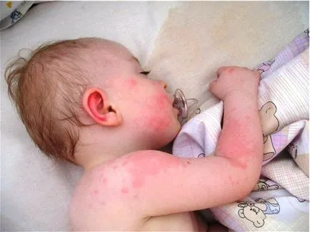 Alergia la pudra pentru copii - spălare, bona urecheat, cum se manifesta simptomele, ce să facă (spălare) Alergia la pudra pentru copii - spalat, bona urecheat, cum se manifesta simptomele, ce să facă