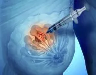 Biopsia și rolul său în diagnosticul și tratamentul cancerului