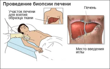 Biopsia și rolul său în diagnosticul și tratamentul cancerului