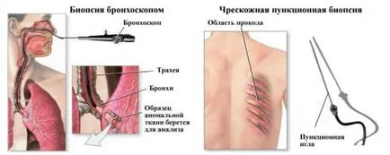 Biopsia și rolul său în diagnosticul și tratamentul cancerului