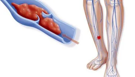 Boli ale vaselor de la nivelul picioarelor 8 de simptome care să sune alarma (navelor) Boli ale vaselor de la nivelul picioarelor 8 de simptome care fac sune alarma