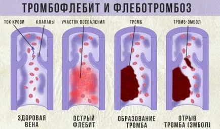 Boli ale vaselor de la nivelul picioarelor 8 de simptome care să sune alarma (navelor) Boli ale vaselor de la nivelul picioarelor 8 de simptome care fac sune alarma