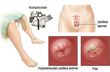 Biopsia de col uterin