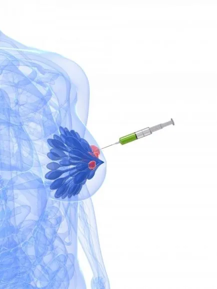 tumori osoase și ale țesuturilor moi (tumoare) - Biopsia tumorile osoase si tesuturilor moi - Biopsia