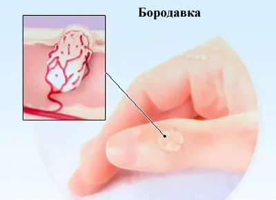 Negi, tipuri de veruci, tratament veruci