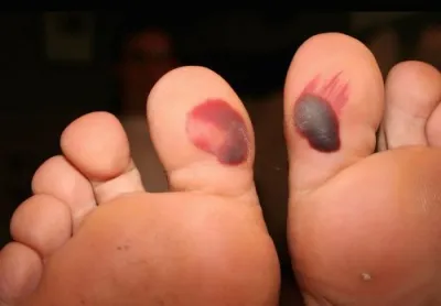 Ce se întâmplă dacă blisterul de spargere pe piciorul ecranului, linia - pentru femei evidenta on-line