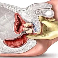 Prostatita care a tratat Prostatita care a tratat
